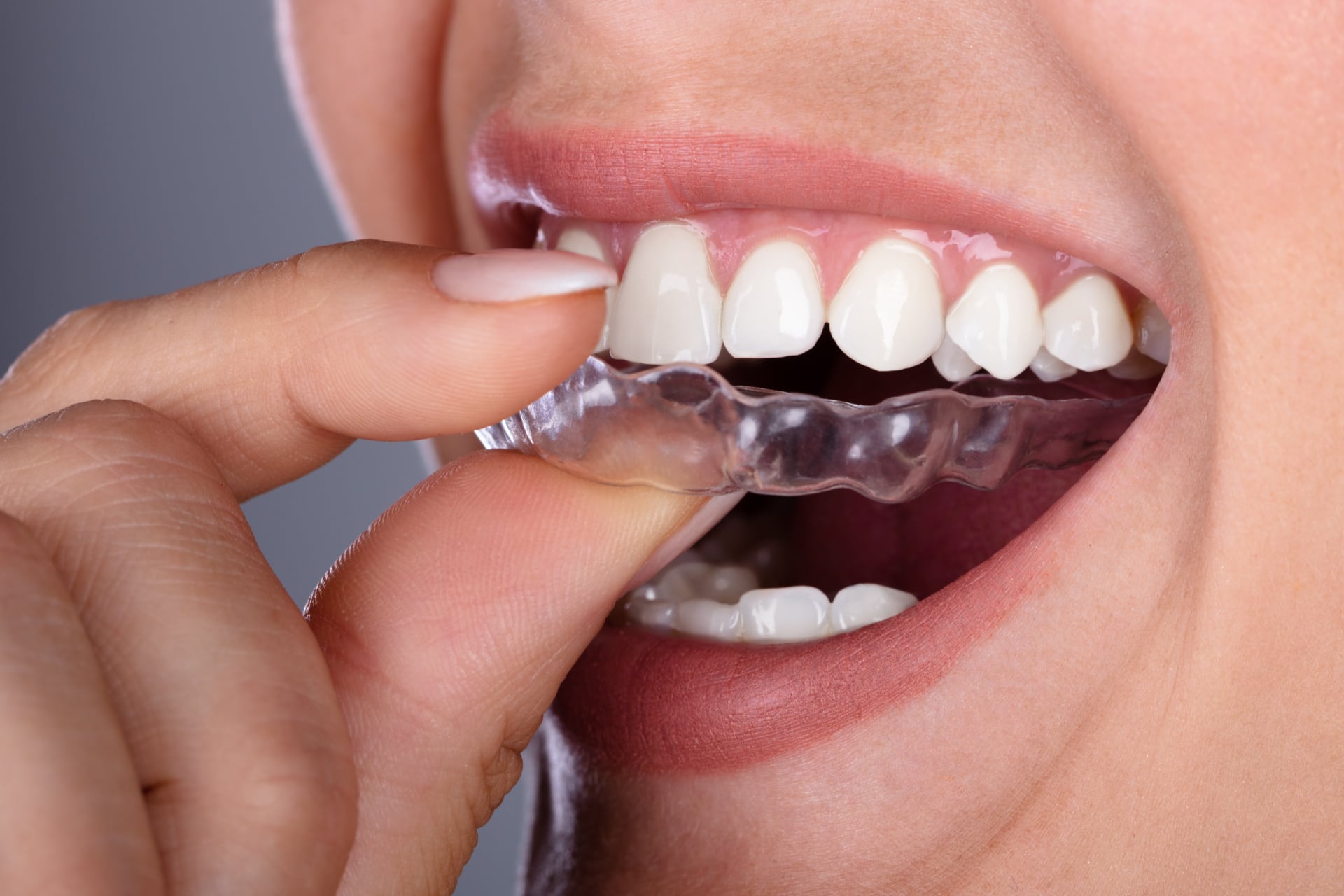 teeth aligners