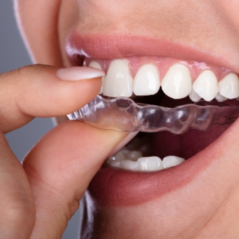 teeth aligners