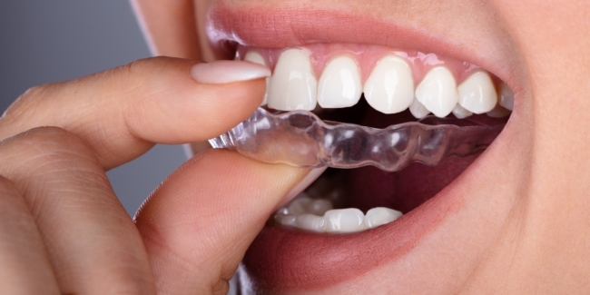 teeth aligners